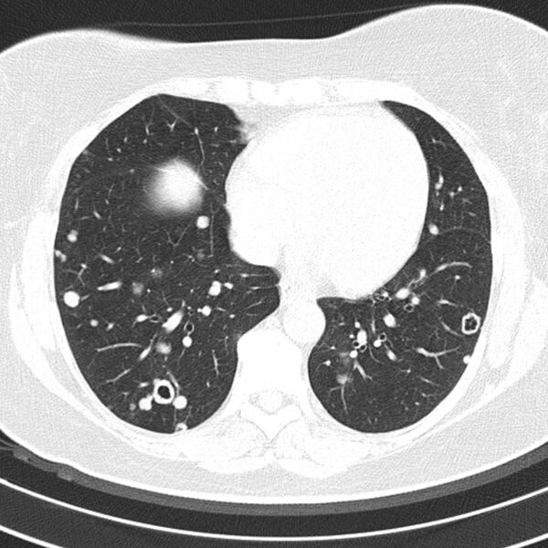 File:Cavitating pulmonary metastases (Radiopaedia 17796-17555 Axial lung window 14).jpg
