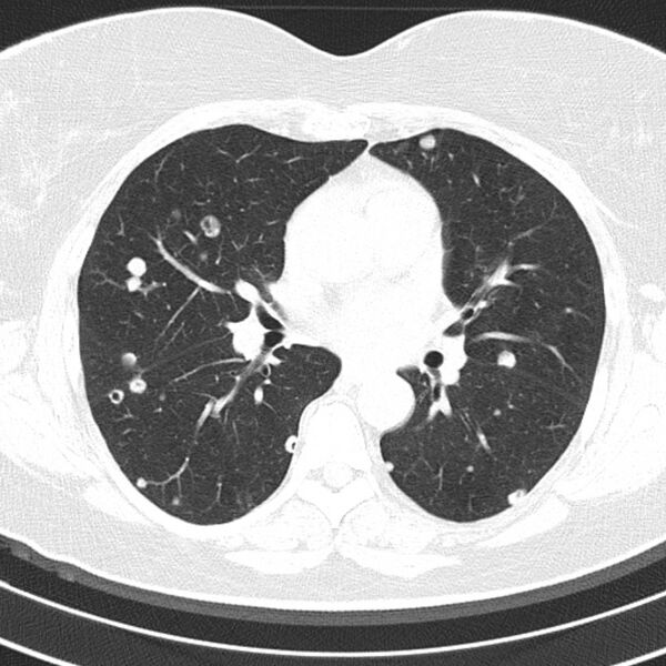 File:Cavitating pulmonary metastases (Radiopaedia 17796-17555 Axial lung window 9).jpg