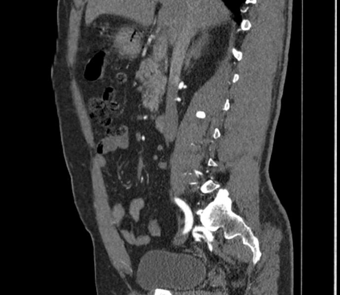 File:Celiac artery dissection (Radiopaedia 52194-58080 B 16).jpg