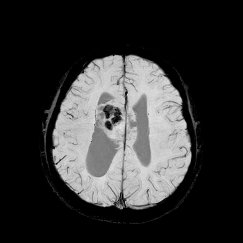 Central neurocytoma (Radiopaedia 79320-92380 Axial SWI 98).jpg