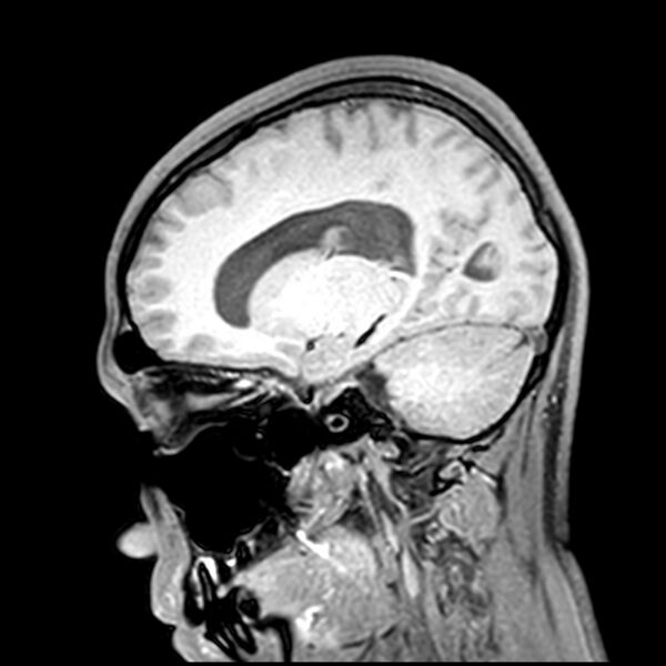 File:Central neurocytoma (Radiopaedia 79320-92380 Sagittal T1 100).jpg