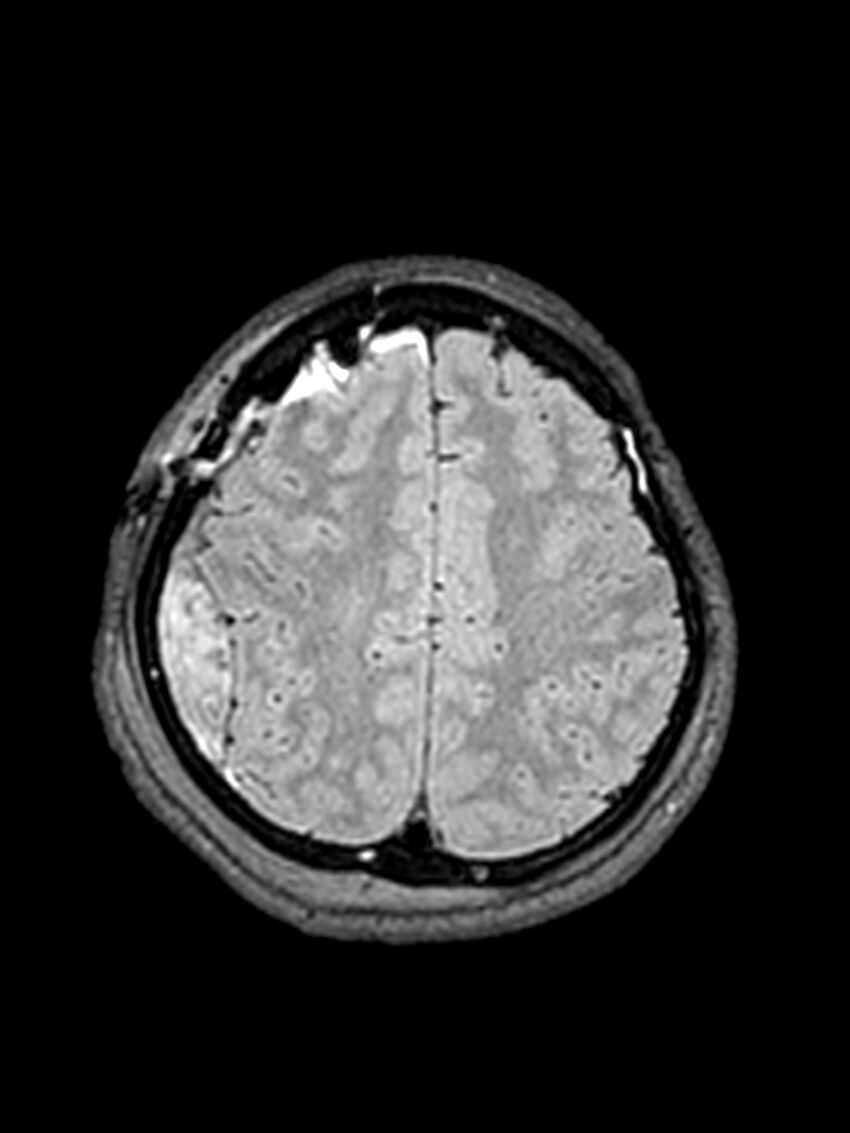 Central neurocytoma (Radiopaedia 79320-92381 Axial FLAIR 51).jpg