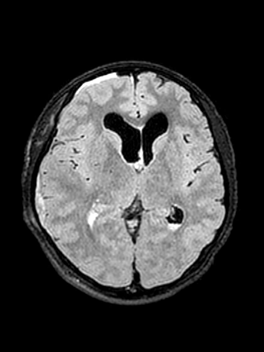 Central neurocytoma (Radiopaedia 79320-92381 Axial FLAIR 90).jpg