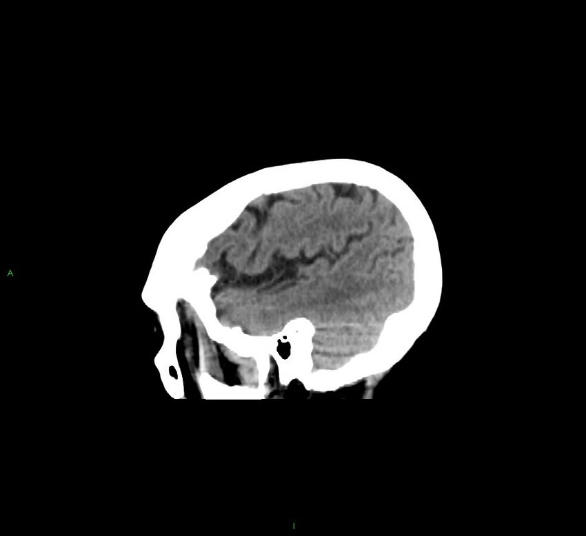 Cerebellar hemorrhage (Radiopaedia 58793-66027 C 42).jpg