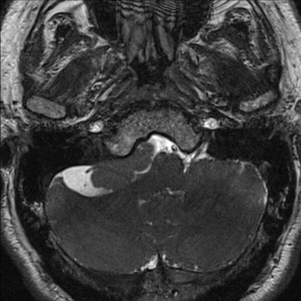 File:Cerebellopontine angle meningioma (Radiopaedia 24459-24764 I 13).jpg