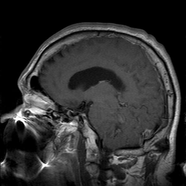File:Cerebellopontine angle meningioma (Radiopaedia 24459-24764 Sagittal T1 C+ 15).jpg