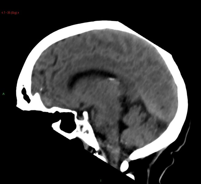 File:Cerebral amyloid angiopathy-associated lobar intracerebral hemorrhage (Radiopaedia 58378-65518 C 35).jpg
