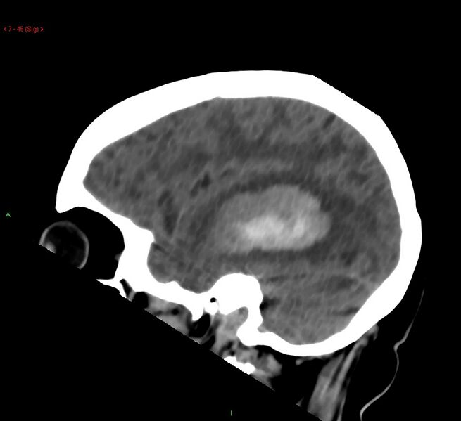 File:Cerebral amyloid angiopathy-associated lobar intracerebral hemorrhage (Radiopaedia 58378-65518 C 45).jpg