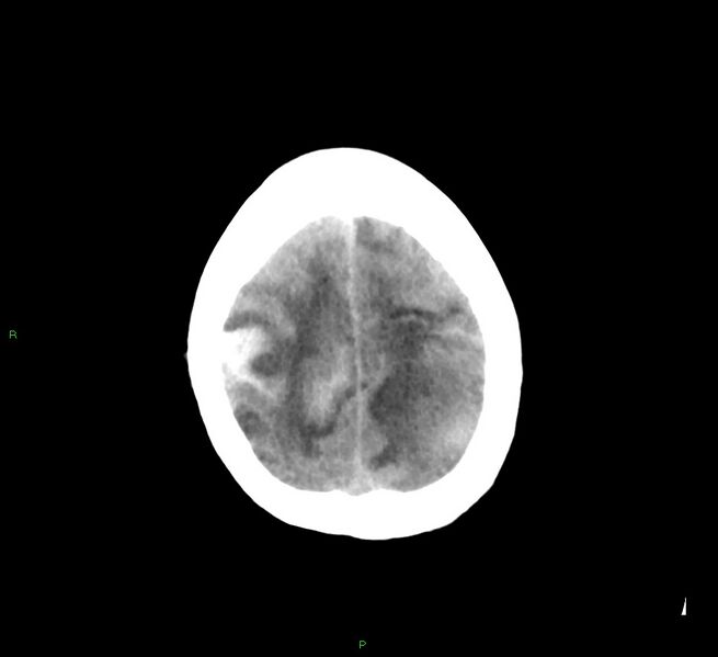 File:Cerebral amyloid angiopathy-associated lobar intracerebral hemorrhage (Radiopaedia 58529-65687 Axial non-contrast 10).jpg