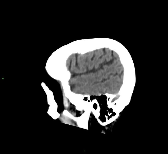 File:Cerebral amyloid angiopathy-associated lobar intracerebral hemorrhage (Radiopaedia 58530-65688 C 9).jpg