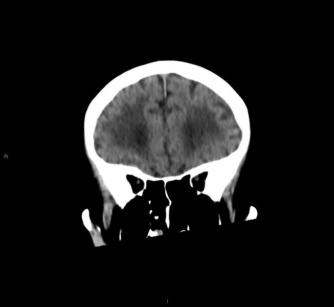 File:Cerebral amyloid angiopathy-associated lobar intracerebral hemorrhage (Radiopaedia 58530-65688 Coronal non-contrast 50).jpg
