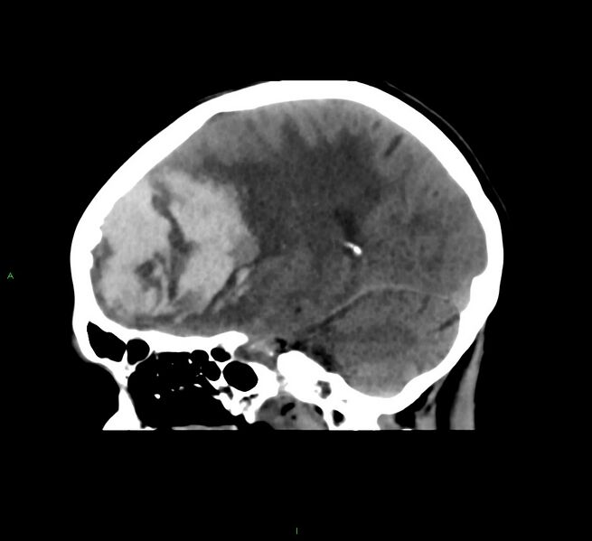 File:Cerebral amyloid angiopathy-associated lobar intracerebral hemorrhage (Radiopaedia 58561-65724 C 30).jpg