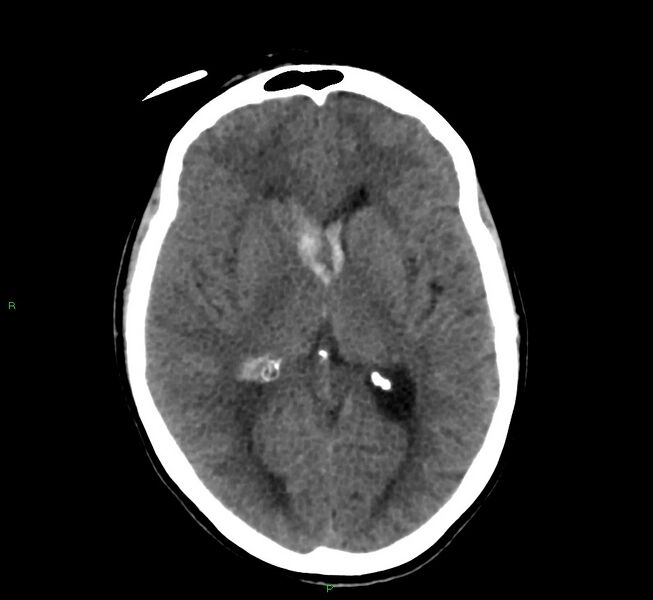 File:Cerebral amyloid angiopathy-associated lobar intracerebral hemorrhage (Radiopaedia 58566-65730 Axial non-contrast 27).jpg