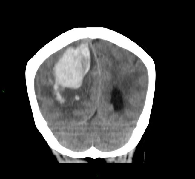 File:Cerebral amyloid angiopathy-associated lobar intracerebral hemorrhage (Radiopaedia 58751-65972 Coronal non-contrast 17).jpg