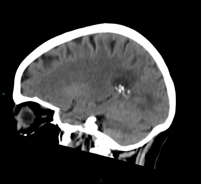 File:Cerebral amyloid angiopathy-associated lobar intracerebral hemorrhage (Radiopaedia 58757-65978 C 35).jpg