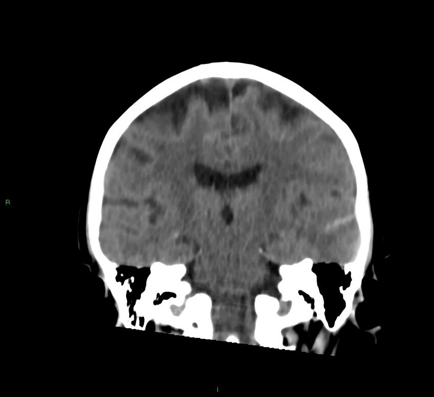 Cerebral amyloid angiopathy-associated lobar intracerebral hemorrhage (Radiopaedia 58757-65978 Coronal non-contrast 33).jpg