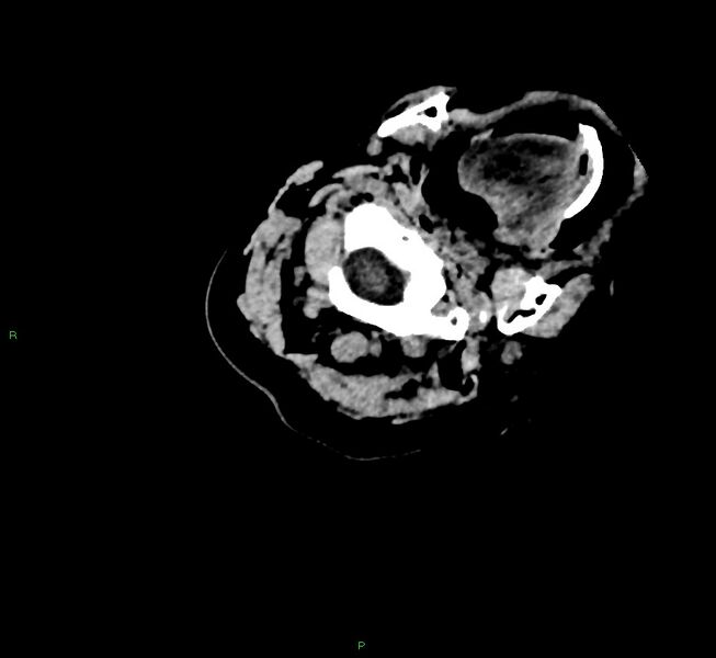 File:Cerebral amyloid angiopathy-associated lobar intracerebral hemorrhage (Radiopaedia 58757-65979 Axial non-contrast 1).jpg