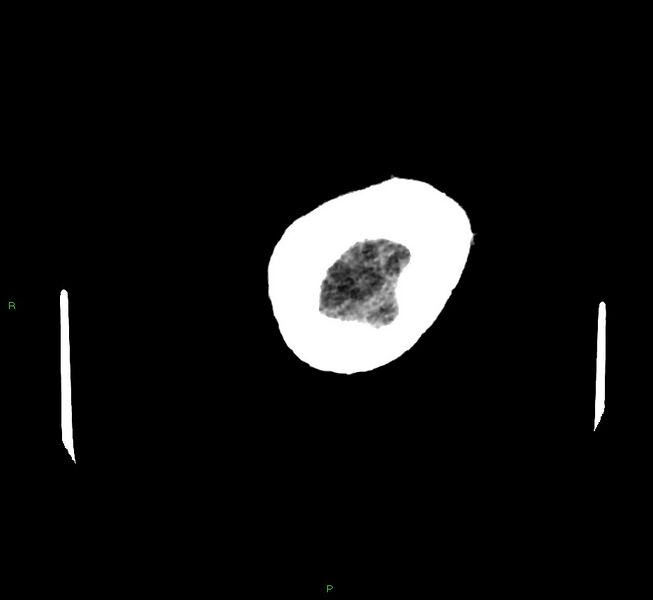 File:Cerebral amyloid angiopathy-associated lobar intracerebral hemorrhage (Radiopaedia 58757-65979 Axial non-contrast 140).jpg