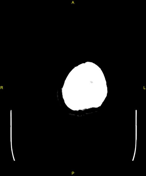 File:Cerebral autosomal dominant arteriopathy with subcortical infarcts and leukoencephalopathy (CADASIL) (Radiopaedia 86108-102051 Axial non-contrast 114).jpg