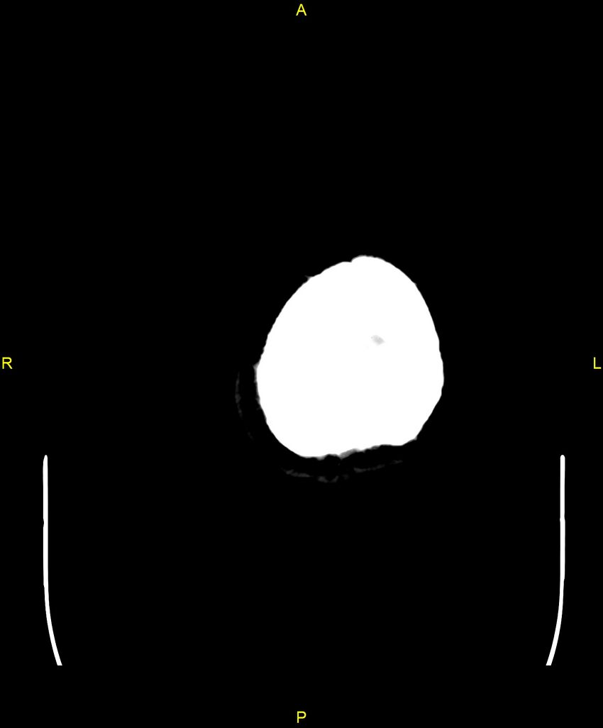 Cerebral autosomal dominant arteriopathy with subcortical infarcts and leukoencephalopathy (CADASIL) (Radiopaedia 86108-102051 Axial non-contrast 114).jpg