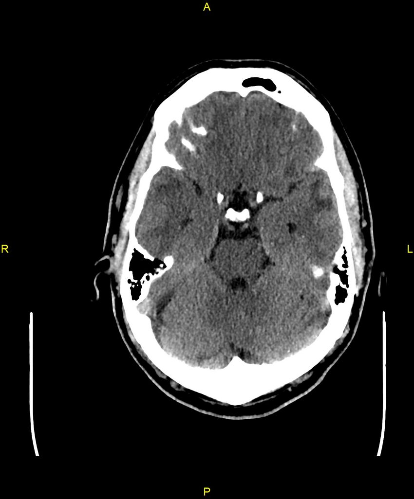 Cerebral autosomal dominant arteriopathy with subcortical infarcts and leukoencephalopathy (CADASIL) (Radiopaedia 86108-102051 Axial non-contrast 34).jpg