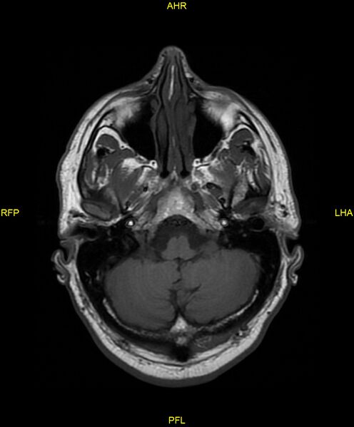 File:Cerebral autosomal dominant arteriopathy with subcortical infarcts and leukoencephalopathy (CADASIL) (Radiopaedia 86108-102054 Axial T1 6).jpg