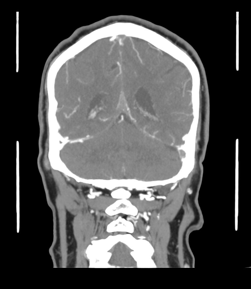 Cerebral dural venous sinus thrombosis (Radiopaedia 86514-102576 B 53).jpg