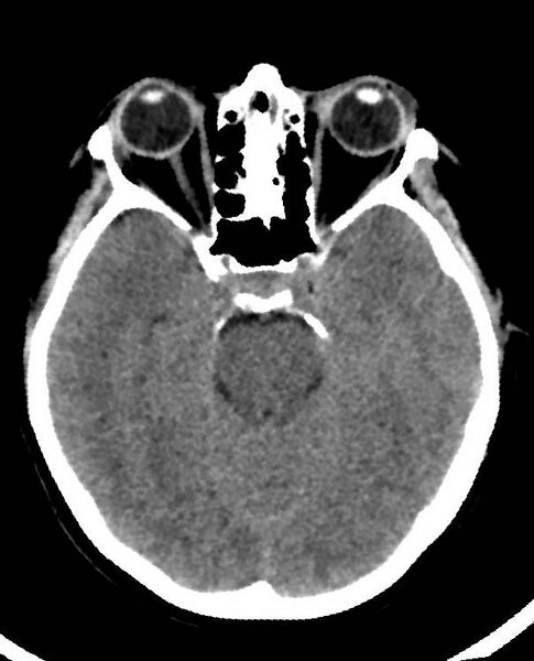 File:Cerebral edema due to severe hyponatremia (Radiopaedia 89826-106938 Axial non-contrast 38).jpg