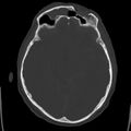 Cerebral hemorrhagic contusions (Radiopaedia 23145-23188 Axial bone window 24).jpg
