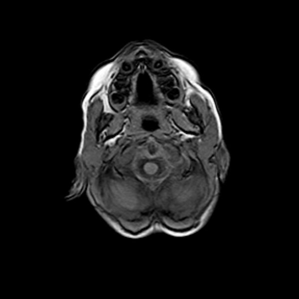 File:Cerebral tuberculoma (Radiopaedia 41152-43932 Axial T1 1).jpg