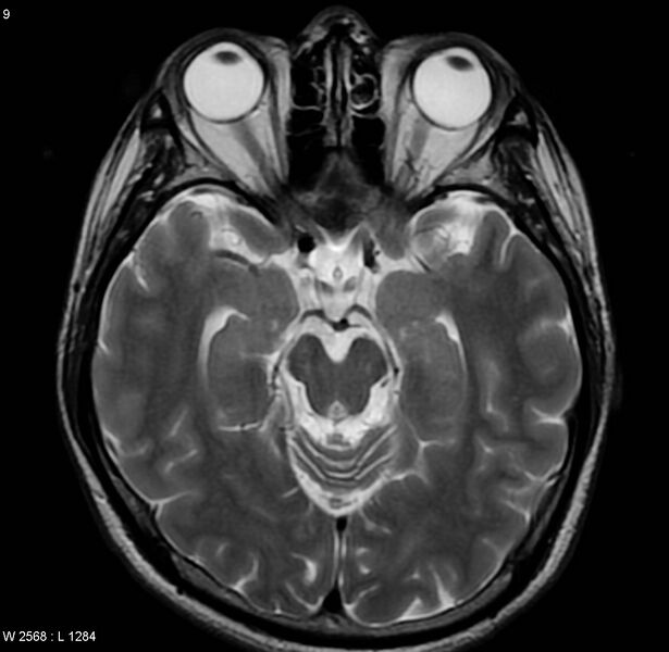 File:Cerebral vasculitis (Radiopaedia 5131-6923 Axial T2 1).jpg