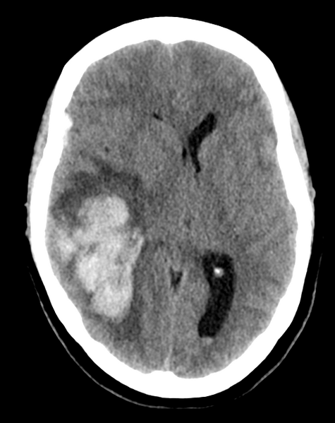 File:Cerebral venous infarct related to dural venous sinus thromboses (Radiopaedia 35292-36803 AXIAL THICK 14).png