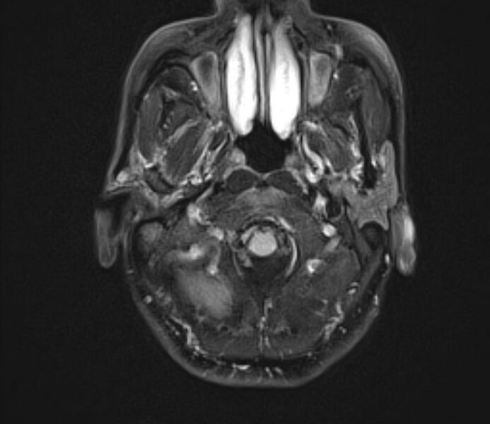 File:Cerebral venous thrombosis (Radiopaedia 71207-81504 Axial FLAIR 4).jpg