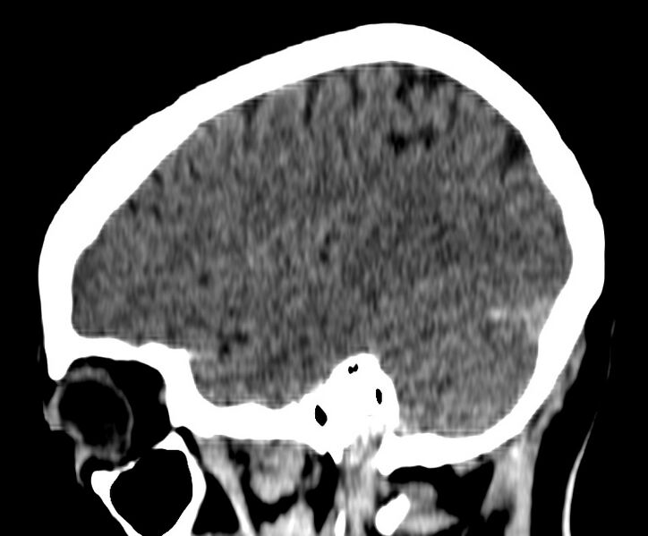 File:Cerebral venous thrombosis - CT only (Radiopaedia 41031-43778 B 32).jpg