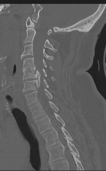 File:Cervical canal stenosis - OPLL and osteophytes (Radiopaedia 47329-51910 Sagittal bone window 43).png