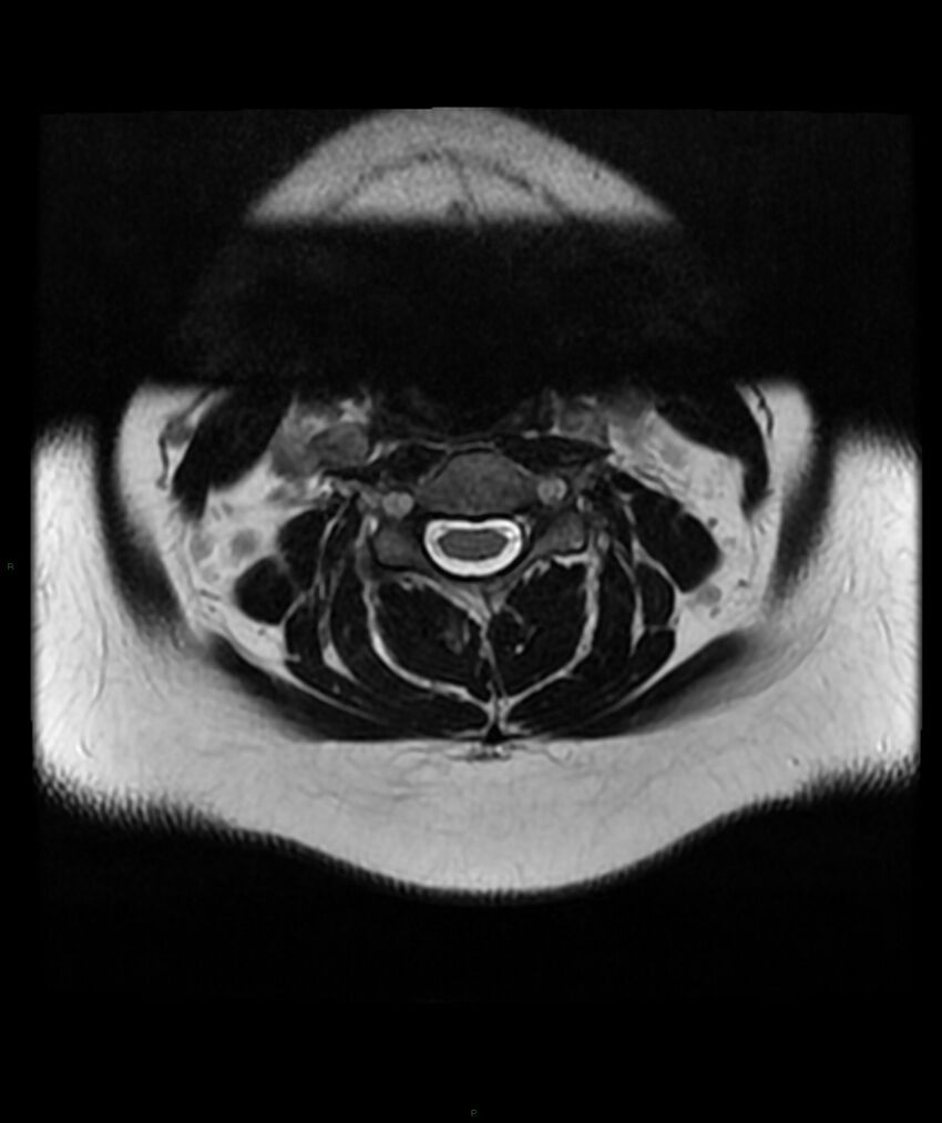 Cervical disc prolapse (Radiopaedia 80258-93598 Axial T2 16).jpg