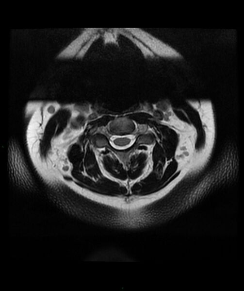 File:Cervical disc prolapse (Radiopaedia 80258-93598 Axial T2 4).jpg