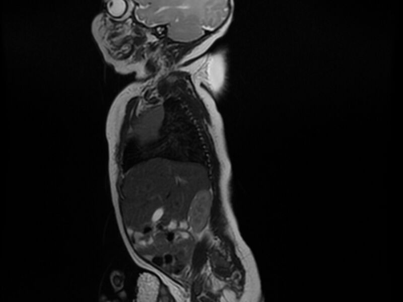 File:Cervical myelomeningocele (Radiopaedia 69569-79479 Sagittal T2 1).jpg