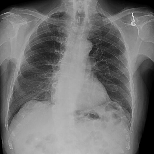 File:Cervical rib (Radiopaedia 11292).jpg