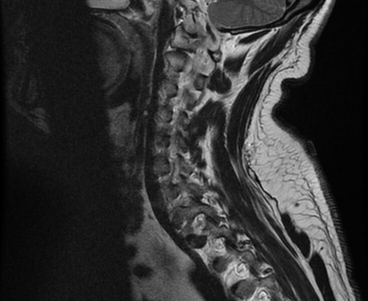 File:Cervical schwannoma (Radiopaedia 72399-82934 Sagittal T2 5).jpg