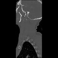 Cervical spine fractures with vertebral artery dissection (Radiopaedia 32135-33078 Sagittal bone window 1).jpg