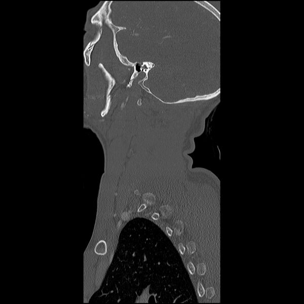 File:Cervical spine fractures with vertebral artery dissection (Radiopaedia 32135-33078 Sagittal bone window 1).jpg