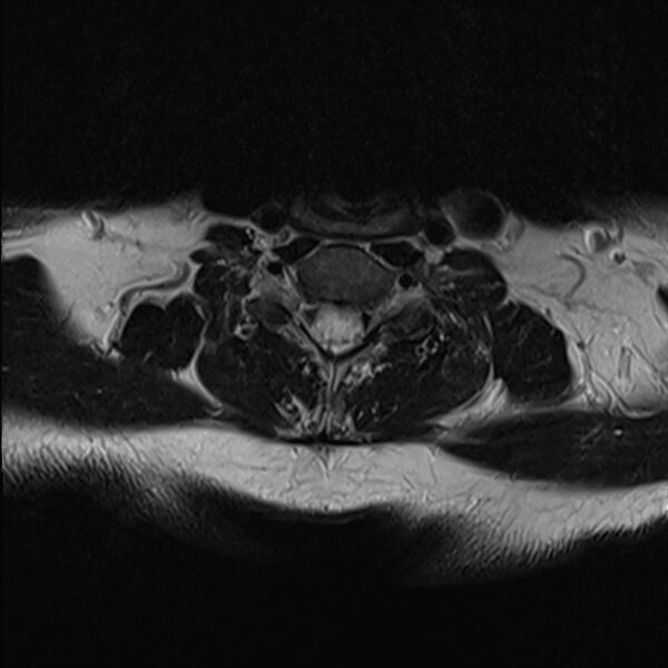 File:Cervical tumor-like myelopathy due to Type V dAVF (Radiopaedia 82461-96604 Axial T2 26).jpg