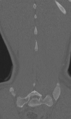 Chance fracture (Radiopaedia 40360-42912 Coronal bone window 63).png