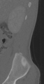 Chance fracture (Radiopaedia 40360-42912 Sagittal bone window 93).png