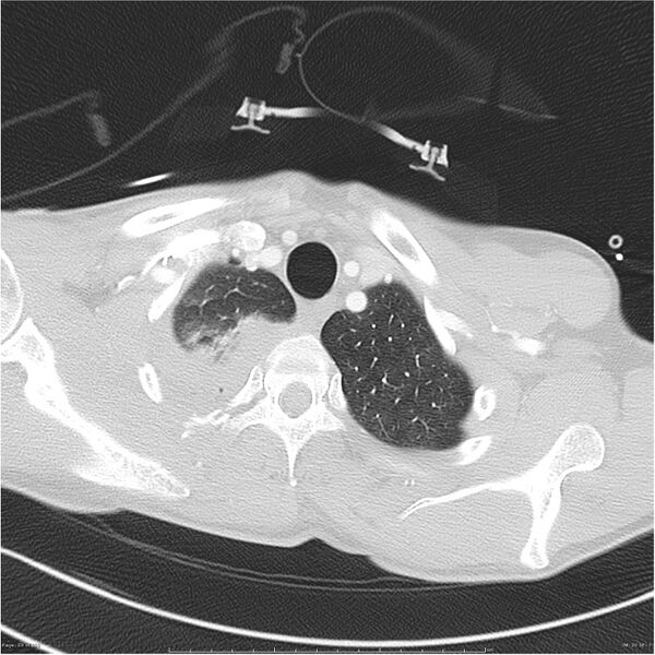 File:Chest and abdomen multi-trauma (Radiopaedia 26294-26425 lung window 20).jpg