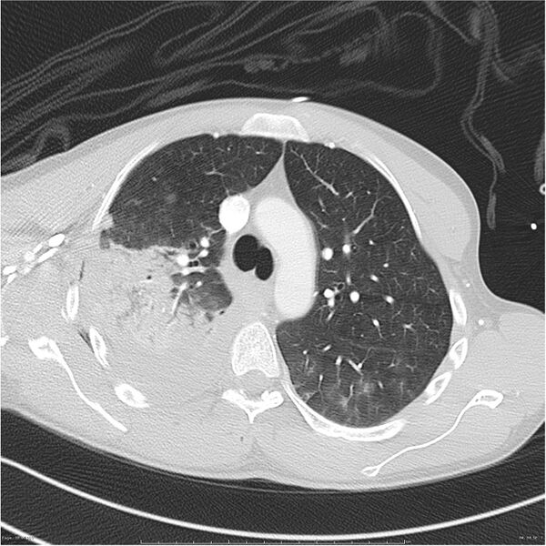 File:Chest and abdomen multi-trauma (Radiopaedia 26294-26425 lung window 38).jpg
