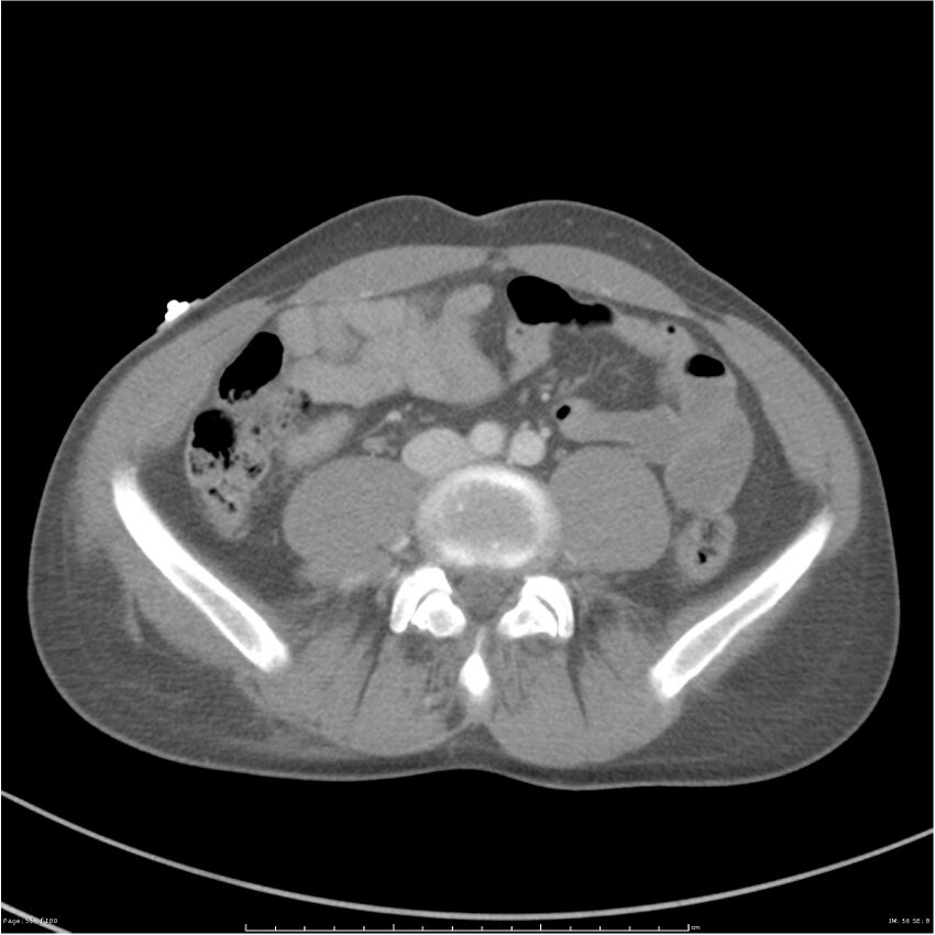 Chest and abdomen multi-trauma (Radiopaedia 26294-26426 A 56).jpg