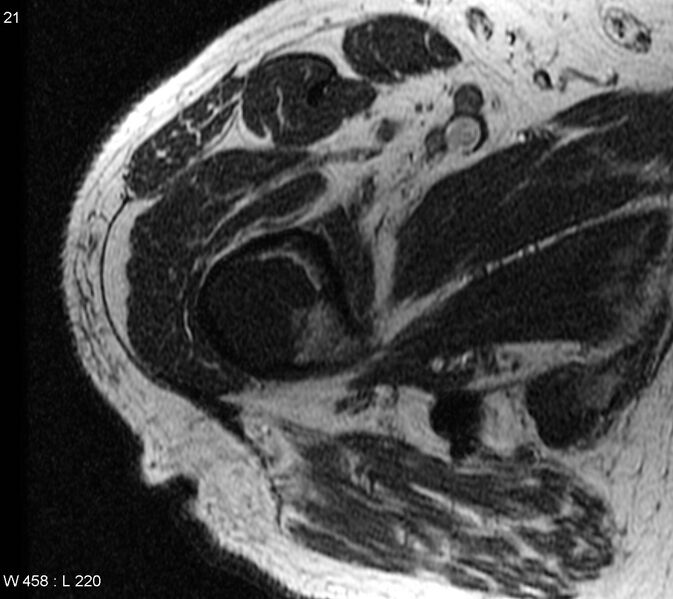 File:Chondrosarcoma - proximal femur (Radiopaedia 6171-7623 Axial T1 1).jpg