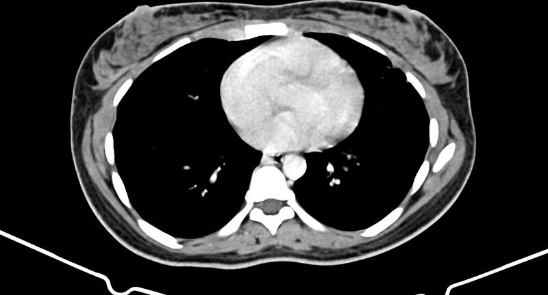 File:Choriocarcinoma liver metastases (Radiopaedia 74768-85766 A 9).jpg